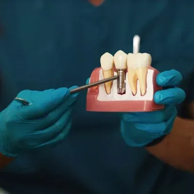 illustrating-dental-implant-procedure-on-model-2026-01-07-07-10-50-utc-rjiupzqq3wsdutwxii45q23i1g2i56340gjbqwv2cg